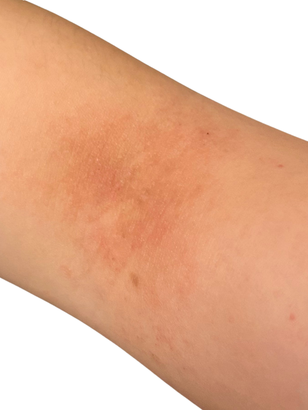 Pre-Flare: faint pink patch on the inner arm on lighter skin, before an eczema flare