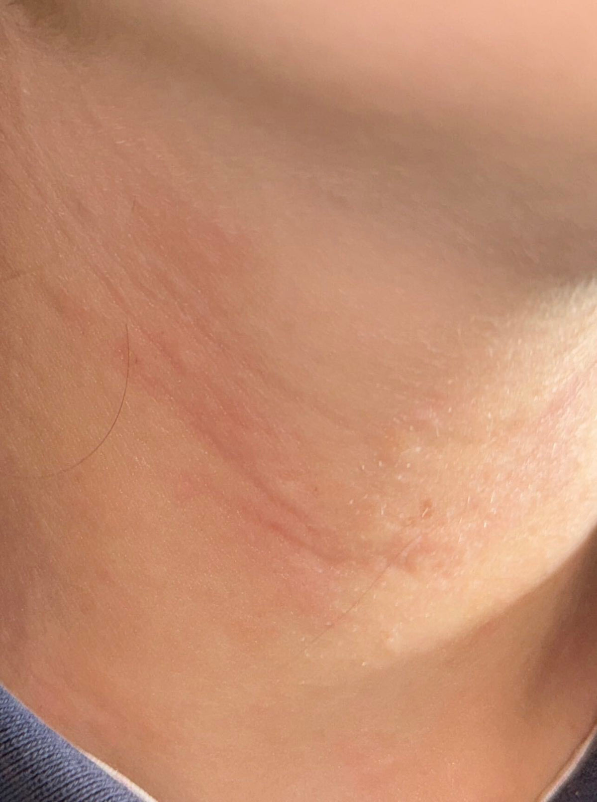 Close-up of the neck just below the jawline with faint pink lines and mild redness along the skin creases, an early sign before an eczema flare