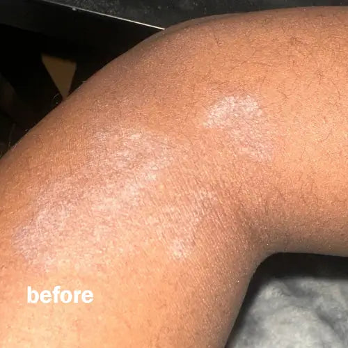 Surge Flare Patch