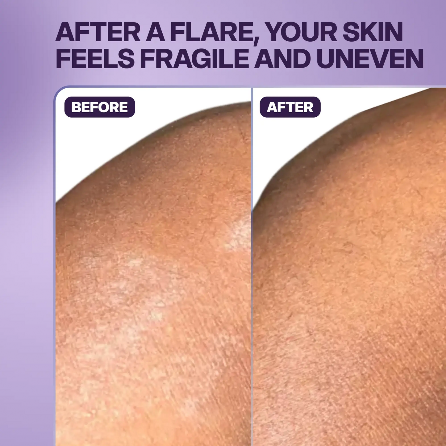 Reset Post-Flare Patch