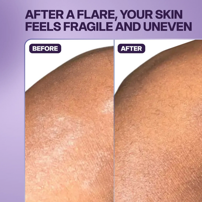 Reset Post-Flare Patch