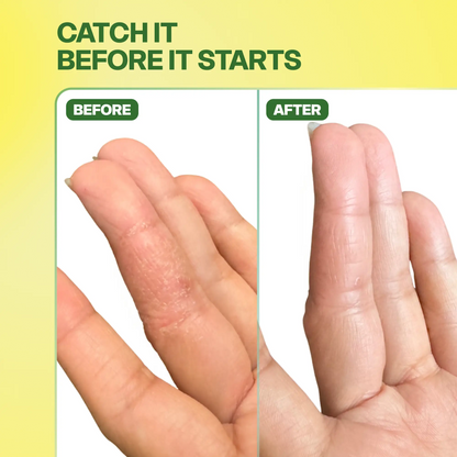 Signal Pre-Flare Patch