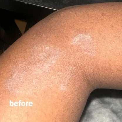 Surge Flare Patch